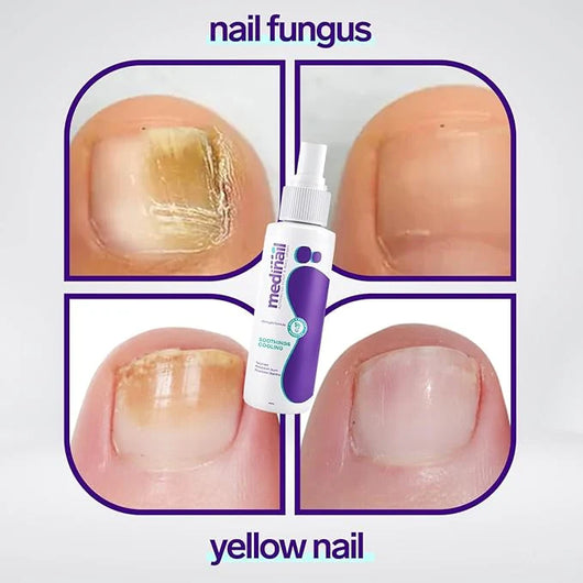 Jaysuin - Nail Fungus Spray